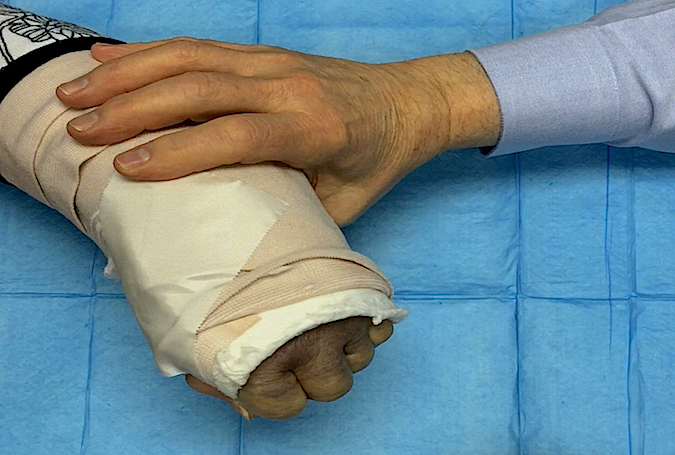 Fracture Crepitus, Deformity, Motion and Tenderness | Hand Surgery Resource